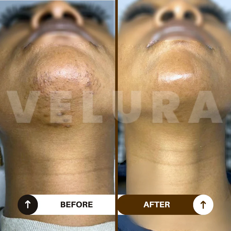 Velura Rotundus Therapy