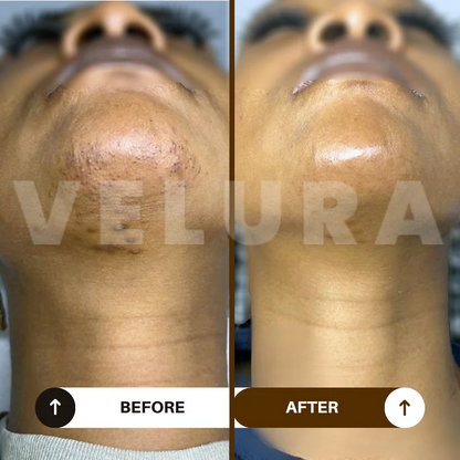 Velura Rotundus Therapy