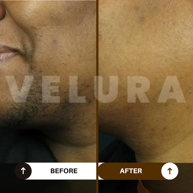 Velura Rotundus Therapy