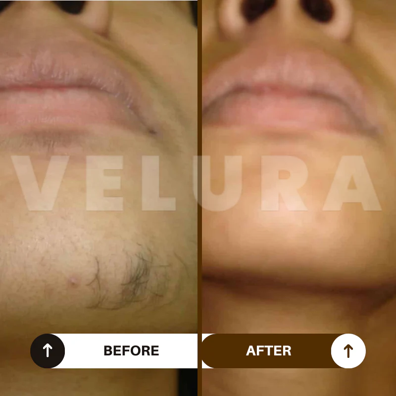 Velura Rotundus Therapy